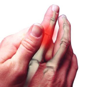 التهاب المفاصل للأصابع: العلاج، الأسباب، الأعراض